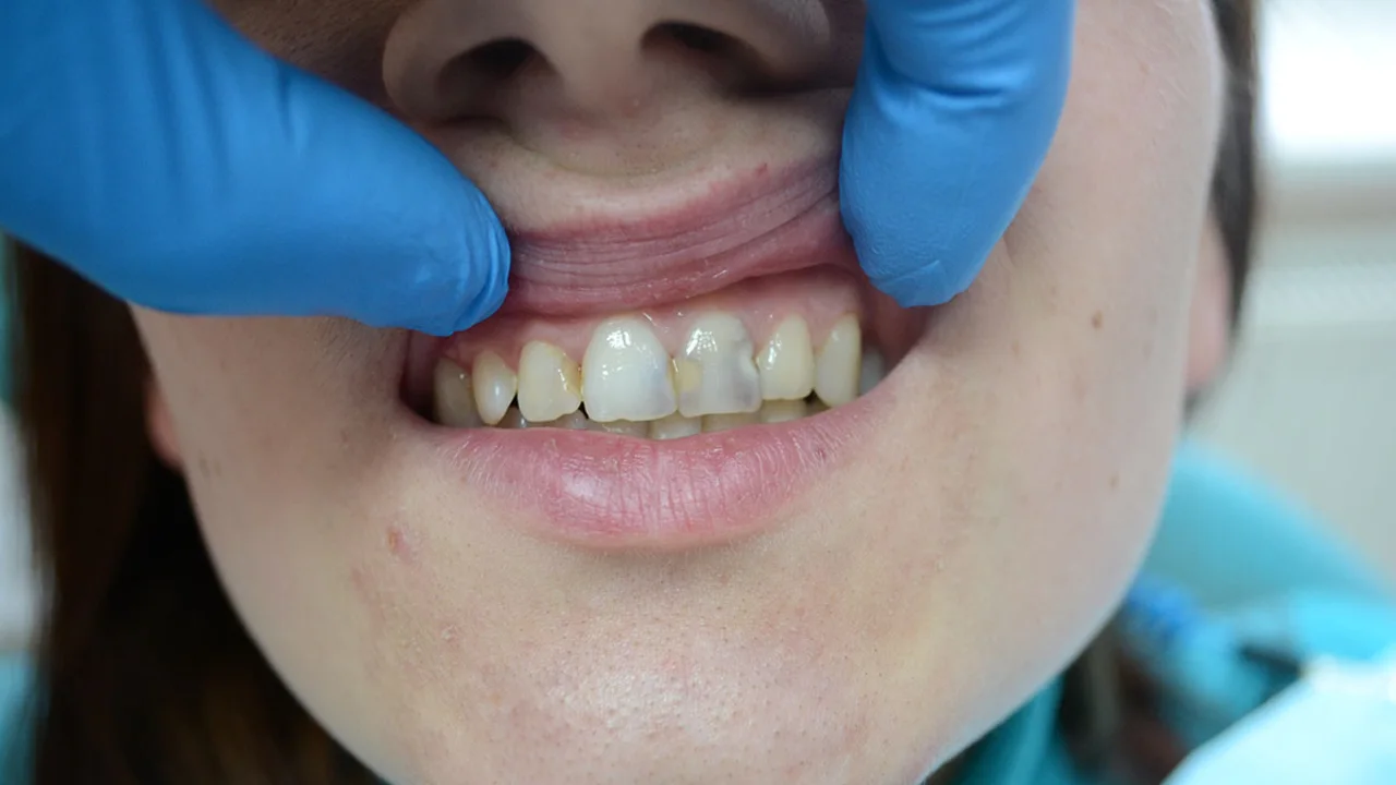 Jaký je dopad kyretáže zubů na vaše zuby