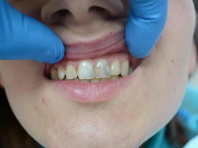 Jaký je dopad kyretáže zubů na vaše zuby